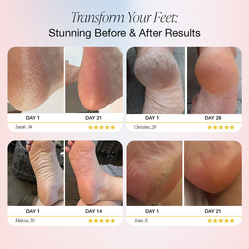 Dermave™ Electric Foot Callus Remover